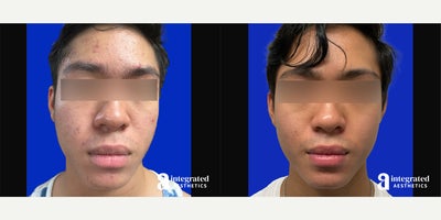 Case: 6831 - before and after photo of 18-24 year old man treated with Accutane by Melissa Chiang, MD, FAAD