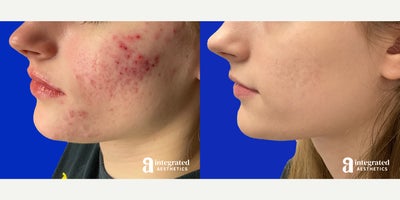 Case: 6832 - before and after photo of 18-24 year old woman treated with Accutane by Melissa Chiang, MD, FAAD