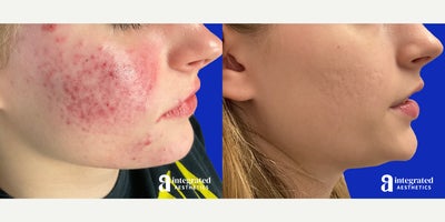Case: 6833 - before and after photo of 18-24 year old woman treated with Accutane by Melissa Chiang, MD, FAAD