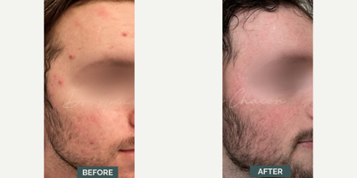 Case: 6834 - before and after photo of Man treated with Accutane by Anna Chacon, MD, FAAD