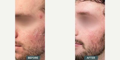 Case 6835 - Man treated with Accutane