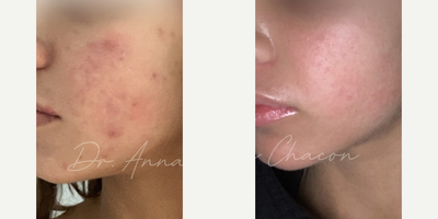 Case 6836 - Woman treated with Accutane