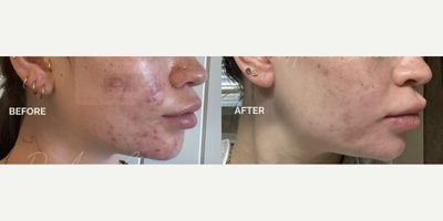Case 6837 - Woman treated with Accutane