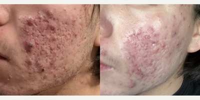 Case 6838 - Man treated with Accutane