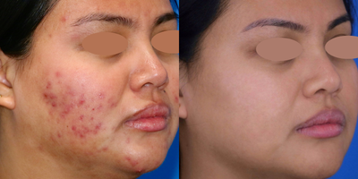 Case 6839 - 25-34 year old woman treated with Accutane, IPL, Skin Tightening, Skin Rejuvenation, Chemical Peel, Microneedling