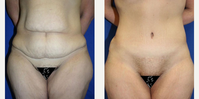 Case 684 - 35-44 year old woman treated with Tummy Tuck