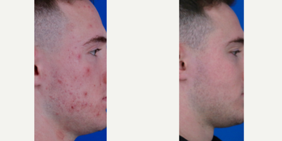 Case 6840 - 18-24 year old man treated with Accutane