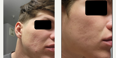 Case 6841 - 25-34 year old man treated with Retin-A, Accutane