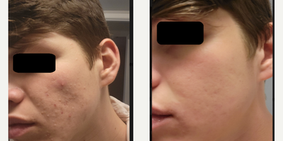 Case 6842 - 25-34 year old man treated with Retin-A, Accutane