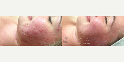 Case 6843 - Woman treated with Accutane