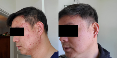 Case 6844 - 45-54 year old man treated with Accutane