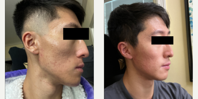 Case 6845 - 18-24 year old man treated with Accutane