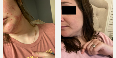 Case 6846 - 25-34 year old woman treated with Accutane