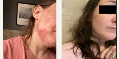 Case 6847 - 25-34 year old woman treated with Accutane