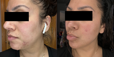 Case 6848 - 35-44 year old woman treated with Accutane