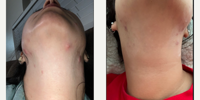 Case 6849 - 25-34 year old woman treated with Accutane