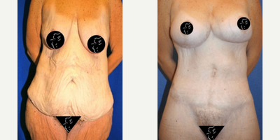 Case 685 - 35-44 year old woman treated with Tummy Tuck