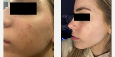 Case 6850 - 17 or under year old woman treated with Accutane