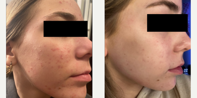 Case 6851 - 17 or under year old woman treated with Accutane