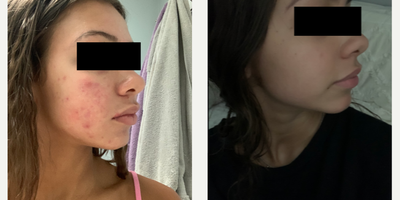 Case 6852 - 17 or under year old woman treated with Accutane