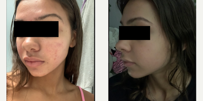 Case 6853 - 17 or under year old woman treated with Accutane