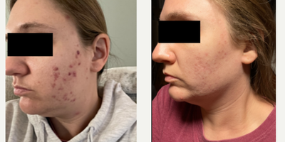 Case 6854 - 25-34 year old woman treated with Accutane