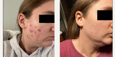 Case 6855 - 25-34 year old woman treated with Accutane