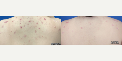 Case 6856 - Woman treated with a combination of an oral medication, medical grade skin care and a series of laser treatments.