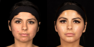 Case 6857 - 25-34 year old woman treated with Accutane