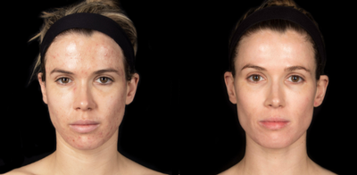 Case 6858 - 18-24 year old woman treated with Accutane