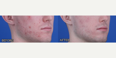 Case 6859 - Man treated with Accutane, Skin Rejuvenation