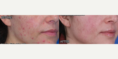 Case 6860 - Woman treated with Accutane, Laser Resurfacing