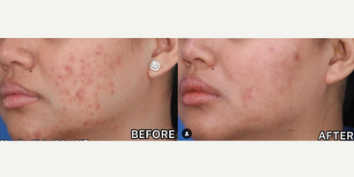 Case 6861 - Woman treated with Accutane