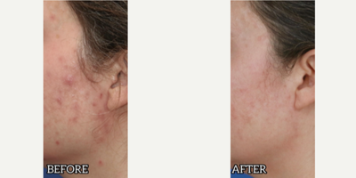 Case 6862 - Woman treated with Accutane, Laser Resurfacing
