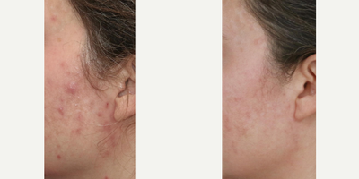 Case 6863 - 35-44 year old woman treated with Accutane