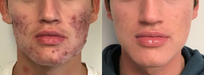 Case 6864 - Accutane Treatment