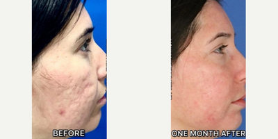 Case 6867 - Woman treated with Accutane