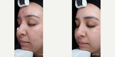 Case 6869 - Woman treated with Accutane