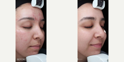 Case 6870 - Woman treated with Accutane