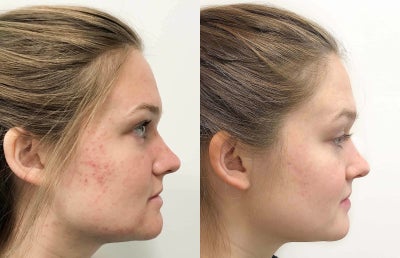 Case 6872 - 15-24 year old woman treated with Accutane
