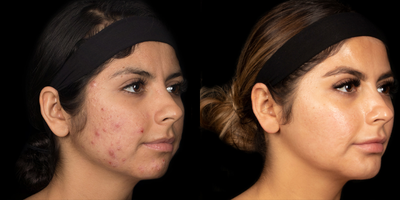 Case 6873 - 25-34 year old woman treated with Accutane