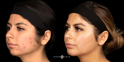 Case 6874 - 25-34 year old woman treated with Accutane