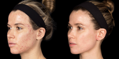 Case 6875 - 18-24 year old woman treated with Accutane