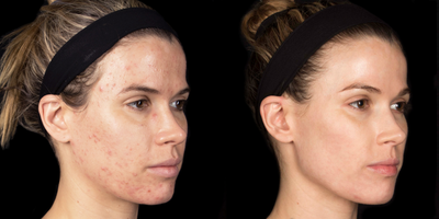 Case 6876 - 18-24 year old woman treated with Accutane