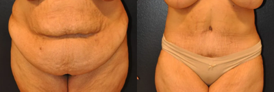 Case 69 - Woman treated with Tummy Tuck