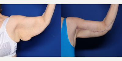 Case: 6909 - before and after photo of 55-64 year old woman treated with Arm Lift by Naveen Setty, MD