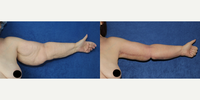 Case: 6910 - before and after photo of 55-64 year old woman treated with Arm Lift by J. Timothy Katzen, MD, FACS