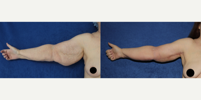 Case: 6911 - before and after photo of 55-64 year old woman treated with Arm Lift by J. Timothy Katzen, MD, FACS