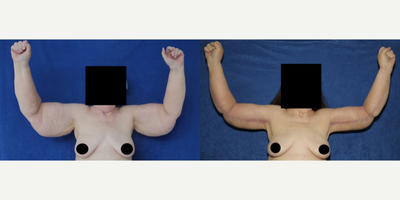 Case: 6912 - before and after photo of 55-64 year old woman treated with Arm Lift by J. Timothy Katzen, MD, FACS