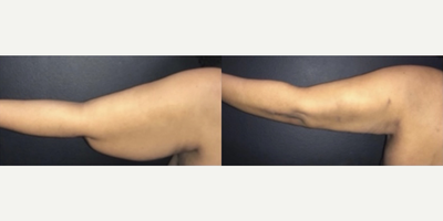 Case: 6913 - before and after photo of Woman treated with Arm Lift by Vivek Bansal, MD